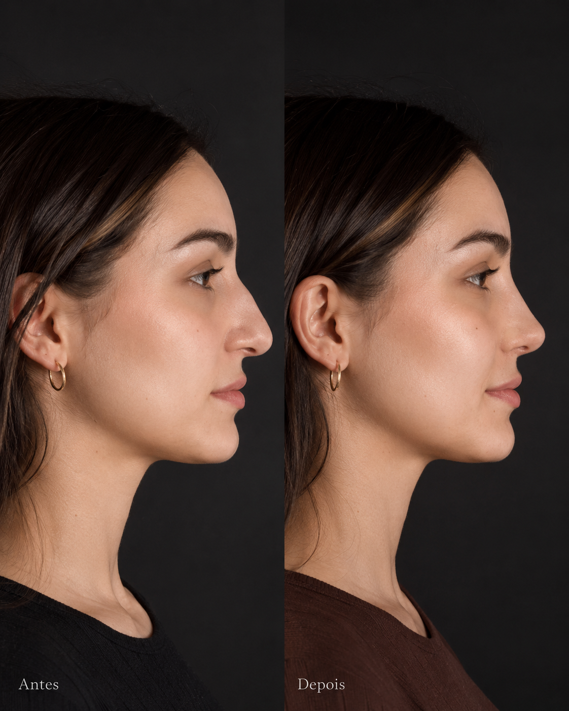 Resultado real de rinoplastia: antes e depois em perfil
